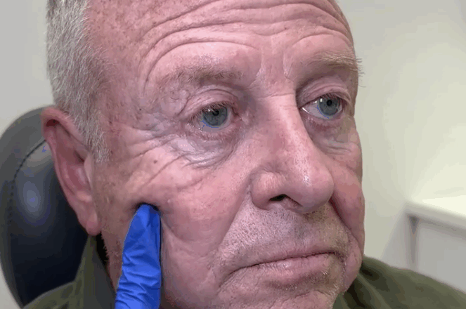 Unbelievable Results: One Facelift Takes 20 Years Off This Man’s Face…